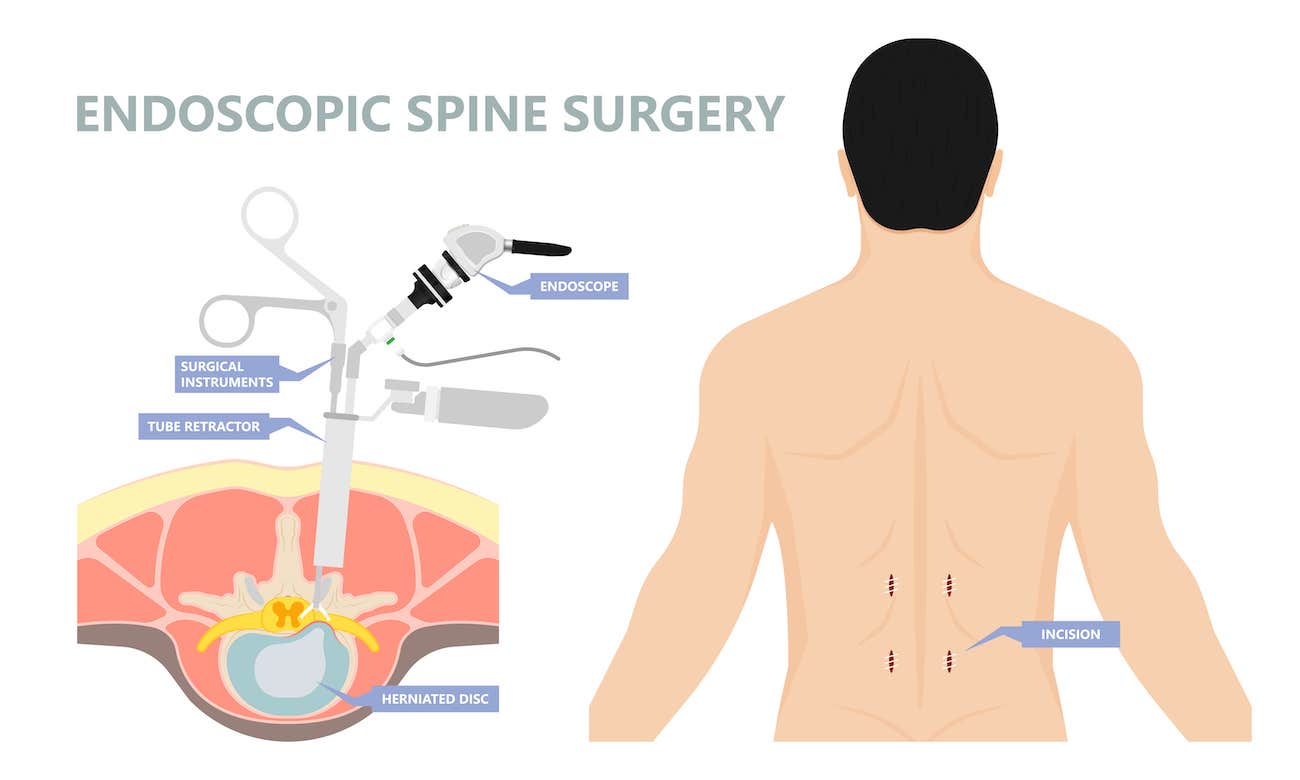 Post Spinal Incision Care Spine Injury | Traumatic Spine Injuries | Singapore