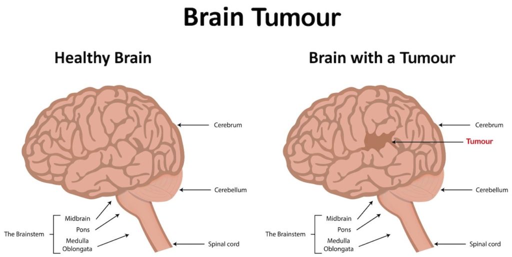 Healthy Brain and Brain with Tumour