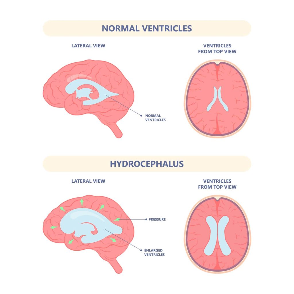 types of Cerebrospinal Fluid Disorders