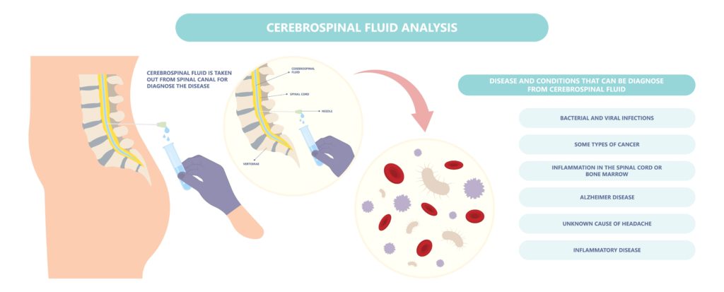 Cerebrospinal Fluid Disorders diagnosis