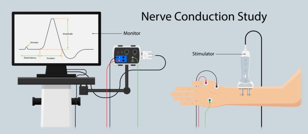 nerve conduction study