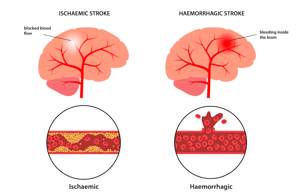 Ischaemic vs haemorrhagic stroke
