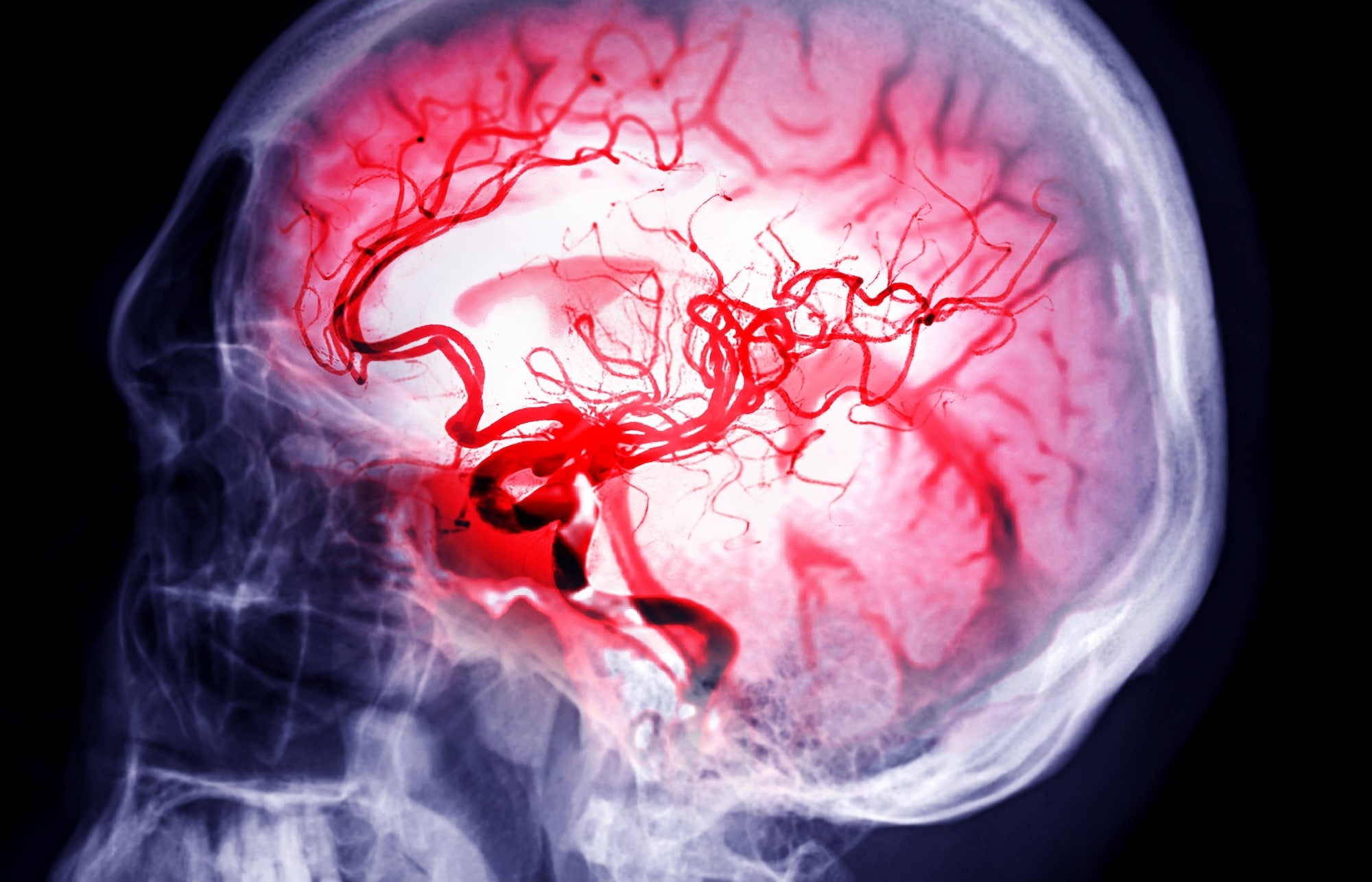 Signs and Symptoms of Aneurysm