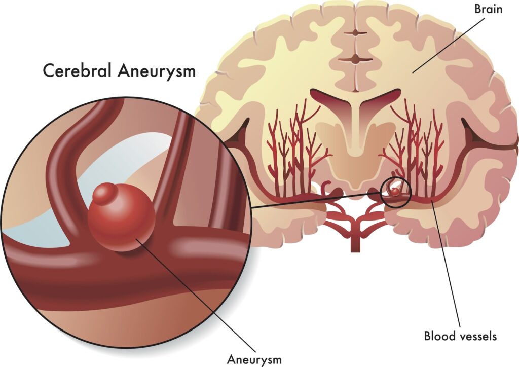 What is Brain Aneurysm