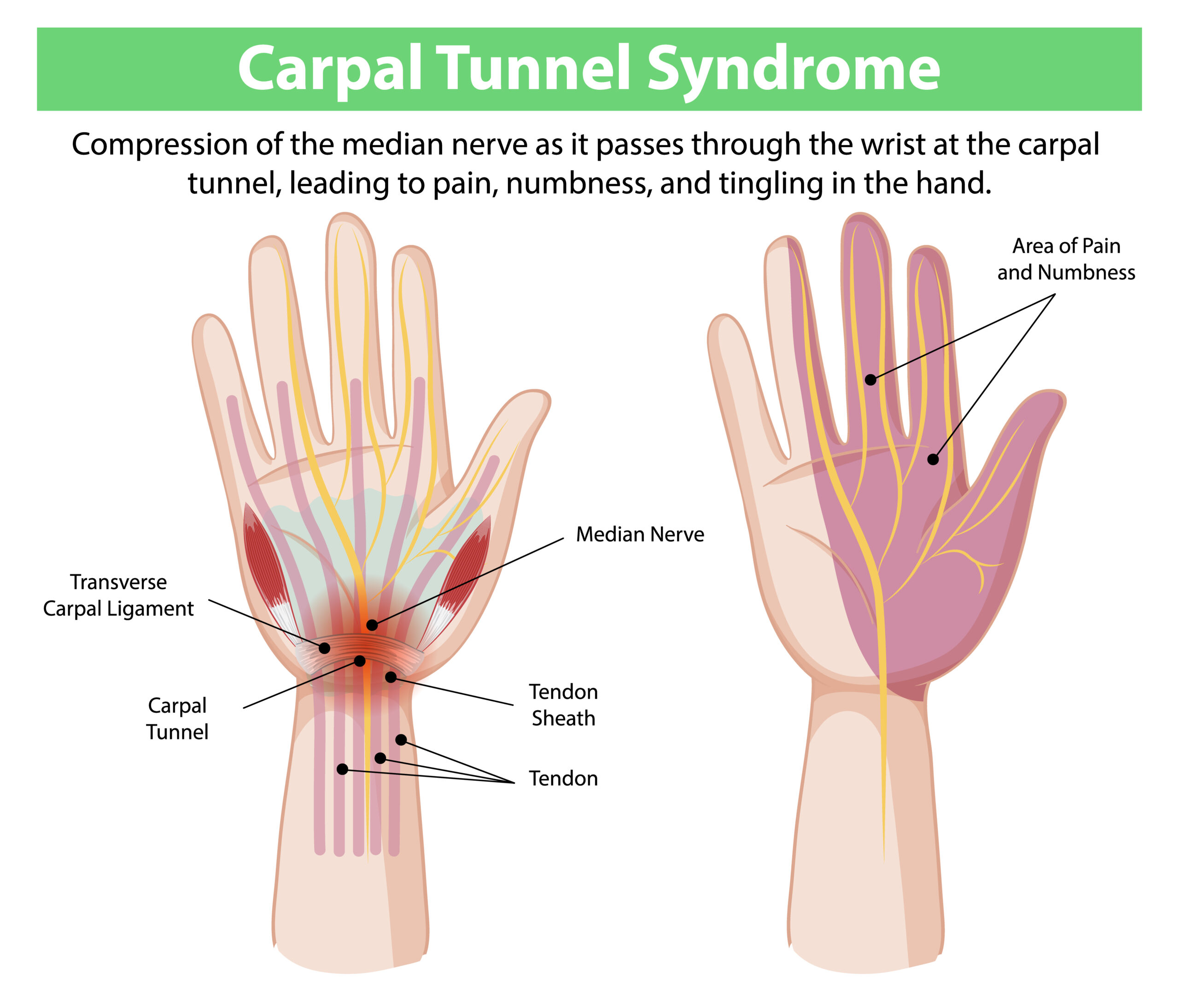 Carpal Tunnel Syndrome